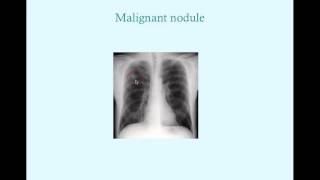 Lung Cancer  CRASH Medical Review Series [upl. by Ellennad]