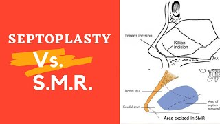 ENT  Nose  SMR and Septoplasty surgery [upl. by Eedoj]