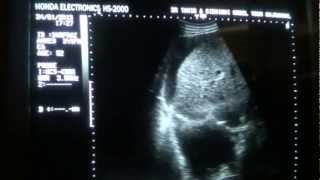 ASCITIC vs PLEURAL FLUID differentiation by ultrasound [upl. by Ragland]