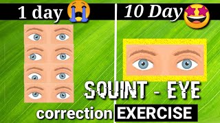 Squint Eye treatment NATURALLY with exercises at Home [upl. by Oiralednac]