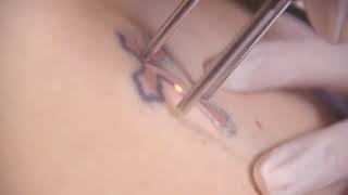 Cutera Enlighten Laser Tattoo Removal Treatment Video [upl. by Maurili]