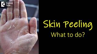 What causes skin peeling from fingers and feet How to manage  Dr Rasya Dixit [upl. by Lamag]