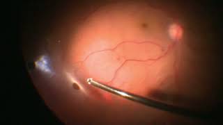 Vitrectomy for Retinal Detachment with multiple holes  Retinal Detachment  Dr Manish Nagpal [upl. by Aicilic]