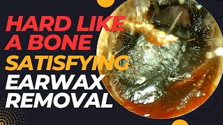 Very Hard Like A BONE Satisfying Earwax Removal [upl. by Eatnom]