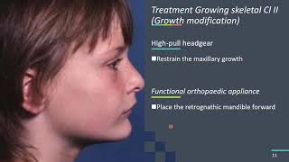 Cl II div 1 Malocclusion [upl. by Nylarahs]