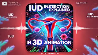 IUD INSERTION EXPLAINED IN 3D ANIMATION [upl. by Pestana]