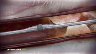 Coronary Orbital Atherectomy [upl. by Durward]