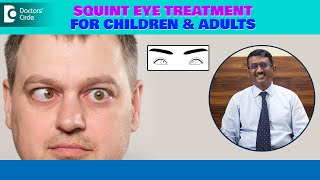 Best Treatment for SquintCrossed Eye How can I fix SQUINT EyeDrSriram RamalingamDoctors Circle [upl. by Appilihp]