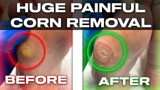 Escape the Pain Watch Massive Corn Removal at Podiatry Clinic [upl. by Mccoy]