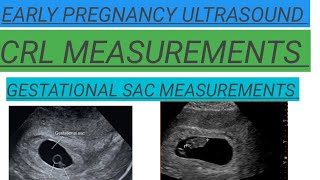 Pregnancy ultrasound showing CRL GESTATIONAL SAC MEASUREMENTS Early Pregnancy ultrasoundyoutube [upl. by Caritta]