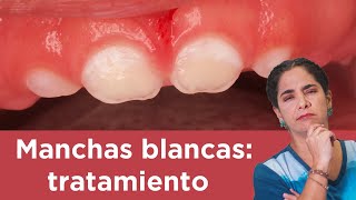 Manchas blancas tratamiento [upl. by Naimad]