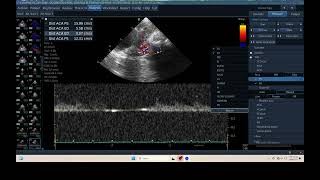 IQ 304 TCD BRAIN ICP CPP ECHOPAC ANALYSIS ULTRASOUND 2 [upl. by Kahn]