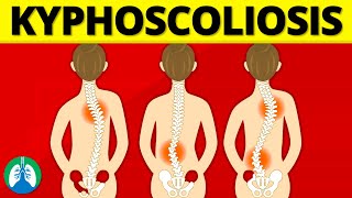 Kyphoscoliosis Medical Definition  Quick Explainer Video [upl. by Enrichetta]