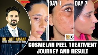 COSMELAN PEEL TREATMENT JOURNEY AND RESULT DAY 1 TO DAY 7 [upl. by Leinto]