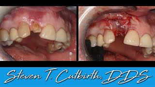 Bone Graft Procedure What to expect [upl. by Pepi]