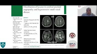 Lacunar Ischaemic Stroke  Clinical Perspectives [upl. by Nnylahs331]