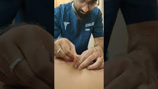 Dry needling for back pain bestphysiotherapy [upl. by Boris908]