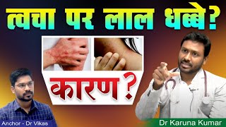 Red Spots over Skin  Causes for Purpura and Excessive bleeding  Dr Karuna Kumar  Hematologist [upl. by Amelina57]