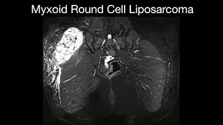 Myxoid Round Cell Liposarcoma [upl. by Deloria]