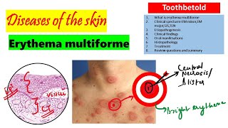 Erythema Multiforme  Etiology Clinical features Histopathology treatment [upl. by Inafetse870]