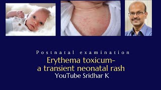 Erythema toxicuma transient neonatal rash Dr Sridhar K rash newbornrash erythematoxicum [upl. by Quill280]