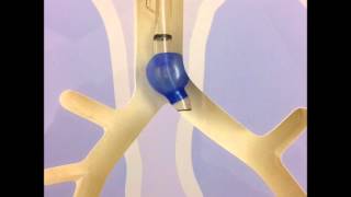 Double lumen endotracheal tubes [upl. by Yonatan]