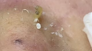 Deep clogged pores extracted Blackhead and Acne Removal [upl. by Mencher]