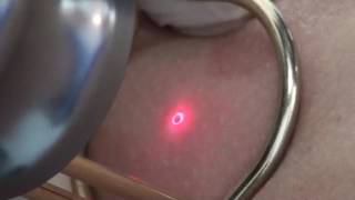 Mole removal fractional CO2 laser [upl. by Norat646]