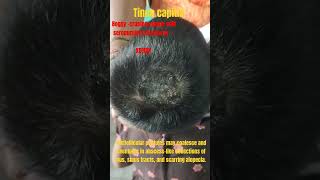 Tinea capitis kerion awarenesshaircarefungalinfectionsdrvaraprasadtineaalopecia childhood [upl. by Gurolinick]