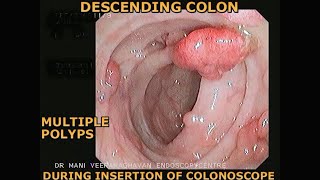 COLON POLYPS  COLONOSCOPY SHOWS MULTIPLE POLYPS  FAMILIAL ADENOMATOUS POLYPOSIS FAP [upl. by Atinrahc]