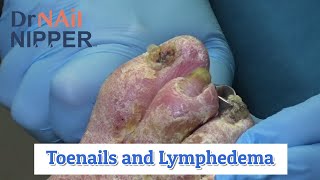 Big Chunks What is Lymphedema Dr Nail Nipper Explains on Extended Video 2020 [upl. by Einahpats]