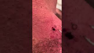 Monster ingrown hair finally out after 10 years [upl. by Yojenitsirk]