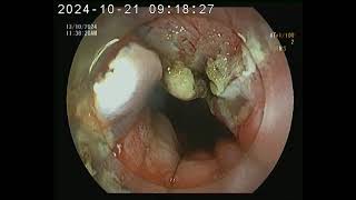 POST Esophageal Leiomyoma resection site [upl. by Elleinet]