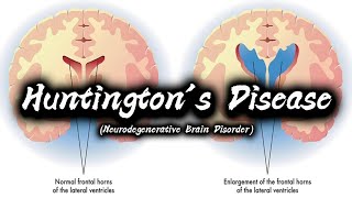 Huntingtons Disease  Types  Symptoms  Causes  Diagnosis  Treatment Options  Preventions [upl. by Annette]