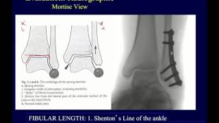 Malleolar ankle fractures  evaluation OTA lecture series III l12a [upl. by Sokim]