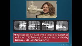 Intraoral radiographic techniques [upl. by Smaj757]