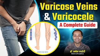 Varicose Veins amp Varicocele Symptoms and Best Treatment Methods in Hindi By Dr Amol Lahoti [upl. by Eisle453]