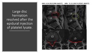 Regenexx MRI Before After Compliation Video [upl. by Jadd]