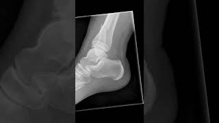 SalterHarris type IV fracture xray ankle shoets [upl. by Elleinwad]