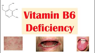 Vitamin B6 Pyridoxine Deficiency  Dietary Sources Causes Signs amp Symptoms Diagnosis Treatment [upl. by Lower]