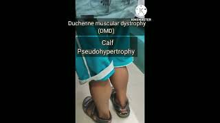 Duchenne muscular dystrophy DMD [upl. by Trudy]