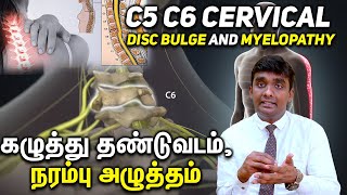 C5 C6 Cervical Disc Bulge and Myelopathy கழுத்து தண்டுவடம் நரம்பு அழுத்தம் Part 1 [upl. by Lennor190]