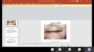 CH 17 Oral Pathology Part 1 [upl. by Justus164]