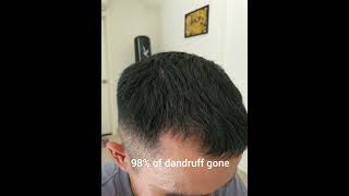 Day 30 Of Minoxidil Treatment  Without Finasteride [upl. by Fowle]