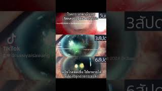 neurotrophic keratitis [upl. by Heid]