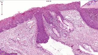 HSIL  High Grade Squamous Intraepithelial Lesion  Histopathology [upl. by Bernhard]