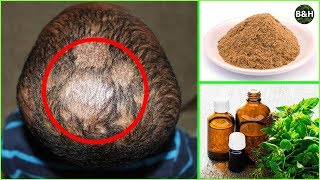 Ringworm Hair Loss Treatment  How To Get Rid of Scalp Fungus Instantly Tinea Capitis [upl. by Nevad]