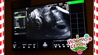 ¡PRIMERA ECOGRAFÍA 🖥 6 SEMANAS 👶POSIBILIDADES de GEMELOS👶¿UNO o DOS✌ [upl. by Rodablas404]