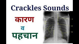 Crackles Sounds and it Causes in Various disease  causes of wheezing [upl. by Elnar]