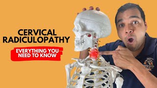 Cervical Radiculopathy Everything You Need To Know To Get Better Without Surgery [upl. by Emee]